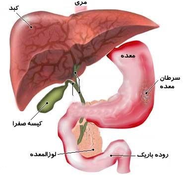 سرطان معده